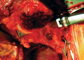 صورة طبية: طول عمر مكون الحُق الأسمنتي في مفصل الورك: مفتاح الاستقرار والديمومة مع الأستاذ الدكتور محمد هطيف في صنعاء