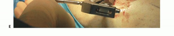 Illustration 18 for High Tibial Osteotomy: Realignment for Lasting Knee Pain Relief