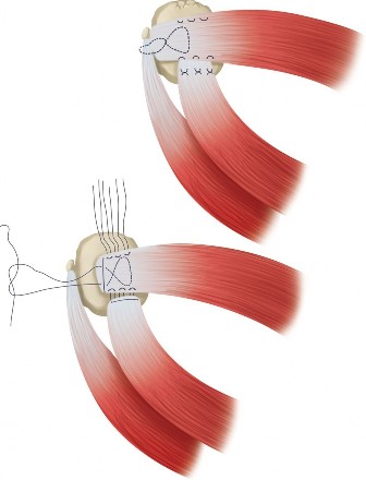Illustration 7 for Irreparable Rotator Cuff Tears: What Are Your Treatment Options?
