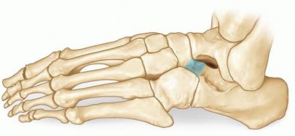 Illustration of resection of calcaneonavicular - Dr. Mohammed Hutaif