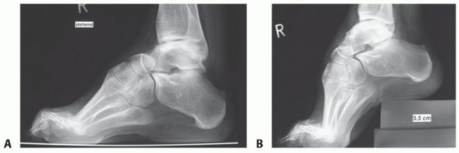 Illustration 3 for How Achilles Tendon Lengthening Fixes Equinocavovarus Foot