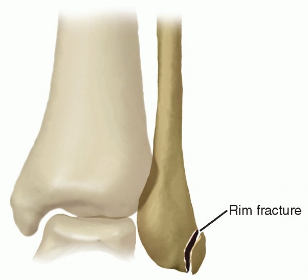 Illustration 8 for Beyond Primary Repair: Solutions for Peroneal Tendon Subluxation