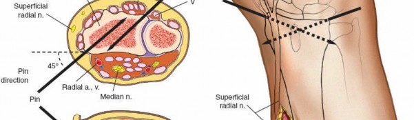 Illustration 11 for Expert Guide: Ulna and Wrist External Fixation Pin Placement