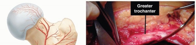 Surgical Dislocation: Optimizing Femoral Headneck Offset for FAI