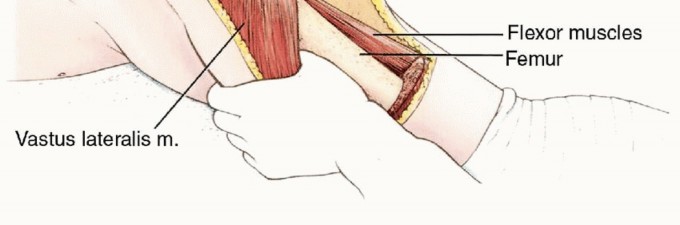 صورة طبية: استئصال نصف الحوض بالرفرفة الأمامية: حلول متقدمة لأورام الحوض الصعبة مع الأستاذ الدكتور محمد هطيف في صنعاء