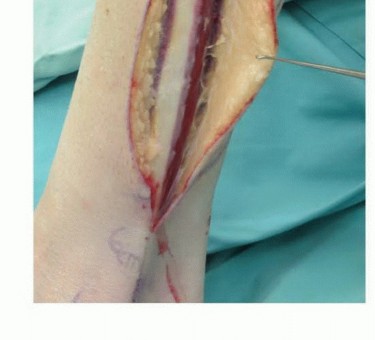 صورة طبية: ترقيع الشظية الوعائي الحر: حلول متقدمة لعيوب العظام المعقدة