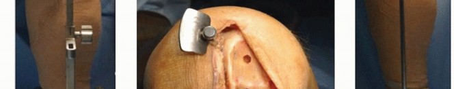 Illustration 13 for Unicondylar Knee Arthroplasty: Is This Your Solution to Knee Pain?