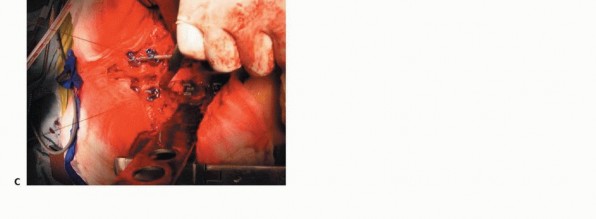 Illustration 26 for Total En Bloc Spondylectomy: Complete Resection for Spinal Tumors