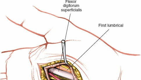 Illustration 234 for Essential Surgical Approaches: Uncover Every Aspect of the Wrist