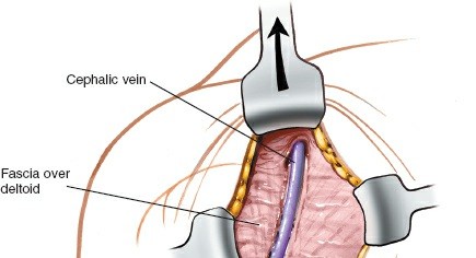 Illustration 12 for Essential Guide: Mastering Every Approach to the Shoulder