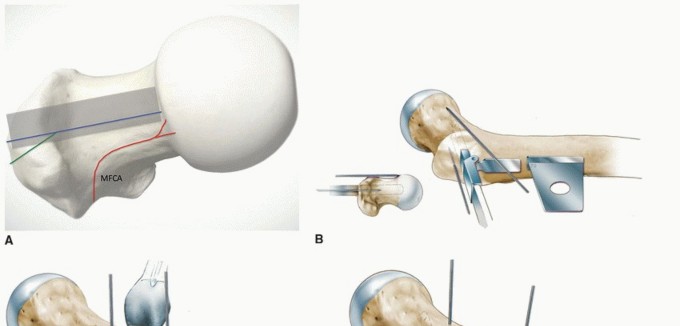 Illustration 32 for Periacetabular Osteotomy: Realigning your hip via the superior pubic ramus
