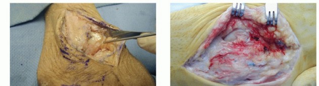Illustration 7 for Lateral Ankle Repair: Maximize Stability with Interference Screw Fixation