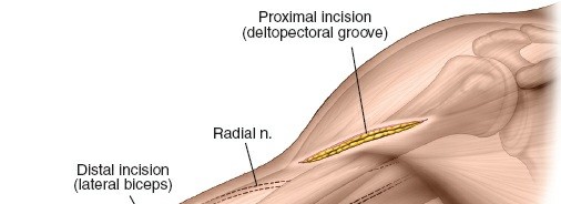 Mastering the Minimally Invasive Anterior Humeral Shaft Approach
