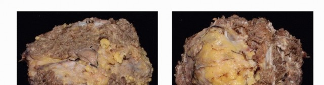 صورة طبية: جراحة أورام العجز: الحفاظ على وظائف الأمعاء والمثانة مع الأستاذ الدكتور محمد هطيف في صنعاء