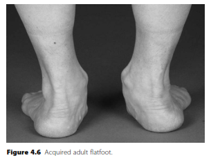 Illustration 2 for Unraveling Acquired Adult Flatfoot: Key Answers for Orthopedics