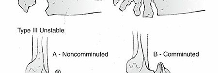 Illustration of olecranon fractures olecranon - Dr. Mohammed Hutaif