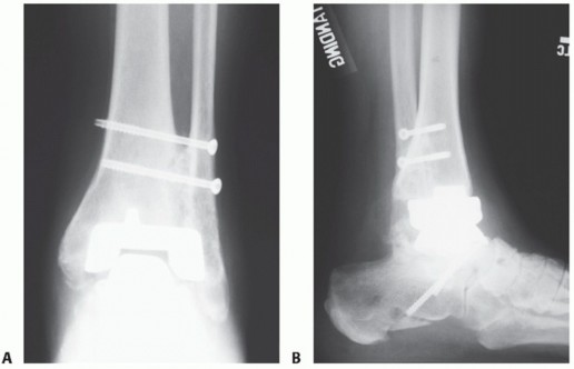 Illustration 38 for Unlock Stability: Medullary Nail Fixation for Tibiotalocalcaneal Arthrodesis