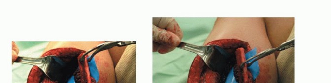 صورة طبية: ترقيع الشظية الوعائي الحر: حلول متقدمة لعيوب العظام المعقدة