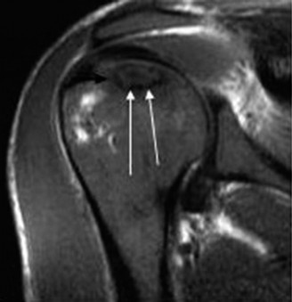 Illustration 28 for Right Shoulder Pain? Avoid This Common X-ray Mistake.