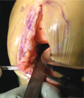 Illustration 21 for Cemented TKA Figure: Your Visual Guide to Surgical Success