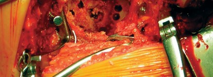 صورة طبية: طول عمر مكون الحُق الأسمنتي في مفصل الورك: مفتاح الاستقرار والديمومة مع الأستاذ الدكتور محمد هطيف في صنعاء