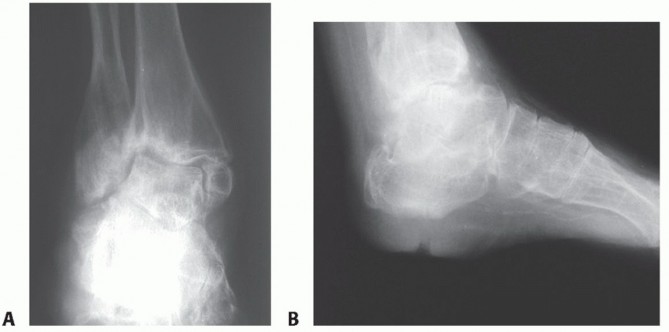 Unlock Stable Arthrodesis with Blade Plate Fixation