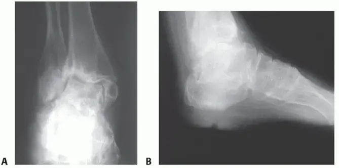 دمج مفاصل الكاحل والقدم الخلفية: الحل النهائي لآلامك مع الأستاذ الدكتور محمد هطيف