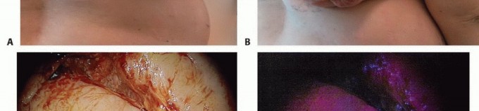 صورة طبية: الاستئصال الموجه لأورام الجهاز العضلي الهيكلي: نهج أكثر أمانًا وفعالية مع الأستاذ الدكتور محمد هطيف