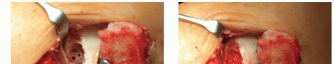 Illustration 8 for Restore Damaged Cartilage with Autologous Chondrocyte Transplantation