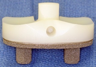 Illustration 11 for Monoblock Total Knee: When to Use & What to Avoid