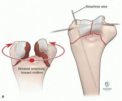 Approaches to The Tibia and Fibula