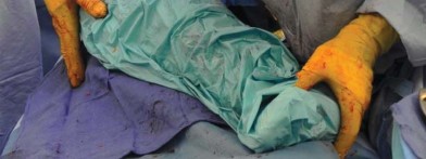 صورة طبية: تقنية الجذع القصير لاستبدال مفصل الورك الكلي: نهج الأستاذ الدكتور محمد هطيف لتدخل جراحي أقل ونتائج أفضل