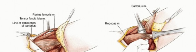 صورة توضيحية لـ استئصال مفصل الورك: دليل شامل للمرضى مع الأستاذ الدكتور محمد هطيف