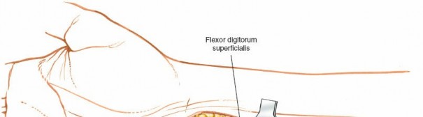 Illustration 94 for Essential Surgical Approaches: Uncover Every Aspect of the Wrist