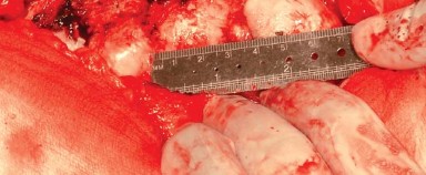 Illustration 9 for Approaches Posterolateral Surgical: A Guide to Enhanced Hip Surgery