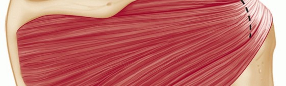 Illustration 14 for Finally Treat Recurrent Posterior Instability of the Shoulder