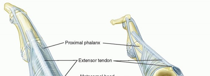 Metacarpophalangeal Joint Synovectomy and Extensor Tendon Centralization in the Inflammatory Arthritis Patient