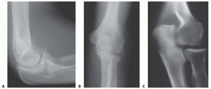 Ulnohumeral (Outerbridge-Kashiwagi) Arthroplasty