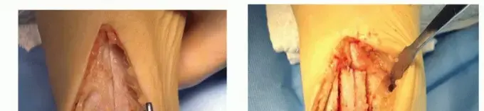 صورة توضيحية لـ الآفات العظمية الغضروفية في الكاحل: دليلك الشامل للعلاج والتعافي مع الأستاذ الدكتور محمد هطيف