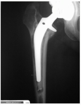 Illustration 2 for Revision THA: Why Extensively Porouscoated Cylindrical Stems Excel