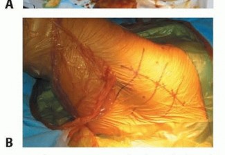 صورة طبية: نصف مفصل الورك: دليلك الشامل لدواعي الاستخدام والأنواع في صنعاء