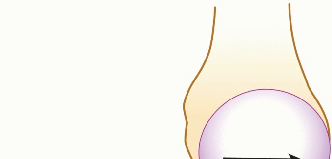 Latarjet for Instability: Bone Loss Solutions, Per Burkhart SS, Lo