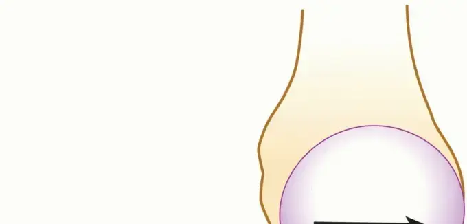 صورة توضيحية لـ عملية لاتارجيت: الحل الأمثل لاستقرار الكتف في حالات فقدان العظم