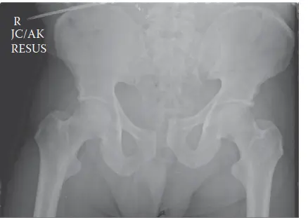 صورة توضيحية لـ إصابة حلقة الحوض عالية الطاقة: دليلك الشامل من الأستاذ الدكتور محمد هطيف في صنعاء