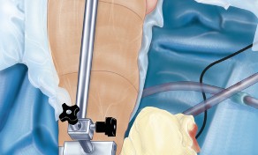 Illustration 34 for Knee Arthroplasty: Avoiding Pitfalls & Benefiting from UKA
