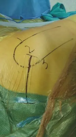 صورة توضيحية لـ جراحة استبدال مفصل الورك بالمدخل الأمامي المباشر بدون طاولة شد: دليل شامل للمرضى في صنعاء