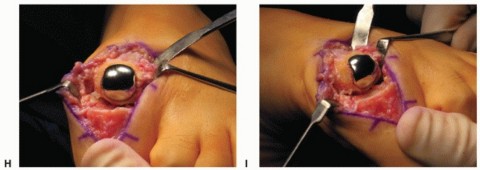 Illustration 49 for End Articular Cartilage Loss: Arthrosurface HemiCAP Resurfacing