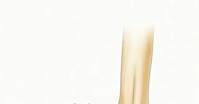 صورة توضيحية لـ علاج إجهاد الكوع الانبساطي بالمنظار: دليل شامل لمرضى اليمن والخليج