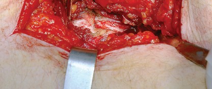 Illustration 28 for Unlock the Figure Posterior Approach to the Hip