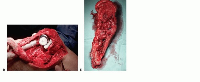 Illustration 19 for Plain Radiograph Showing MBD: Surgical Planning to Prevent Failures